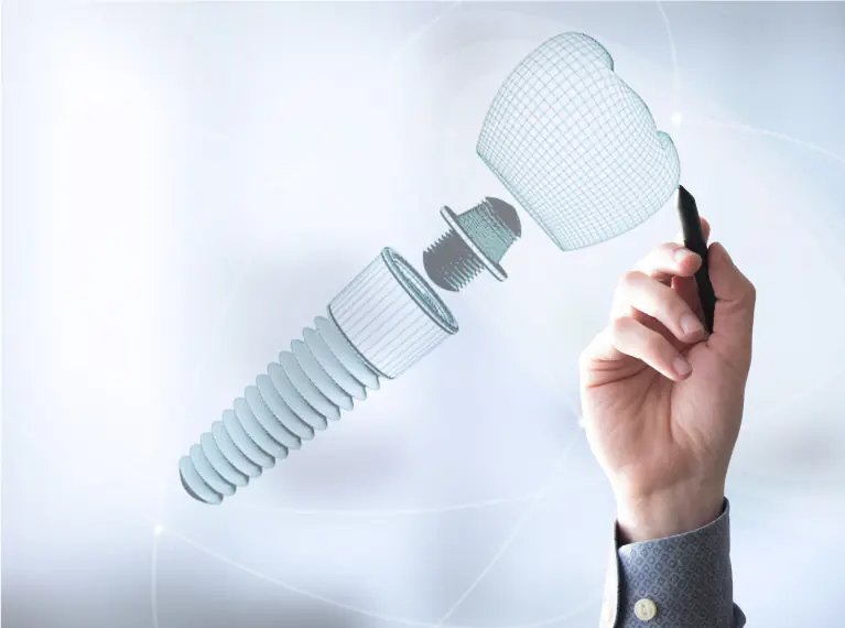 Dental Implant Treatment in Ahmedabad