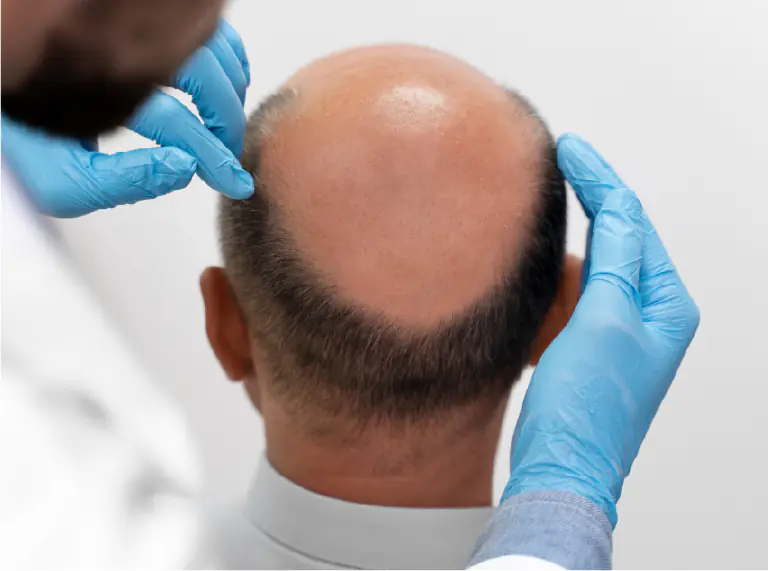 Hair Transplant Treatment in Ahmedabad