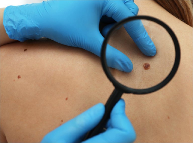 mole & skin tag removal in ahmedabad