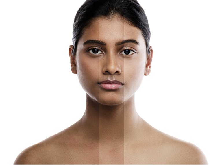 Skin Lightening & Whitening Treatment