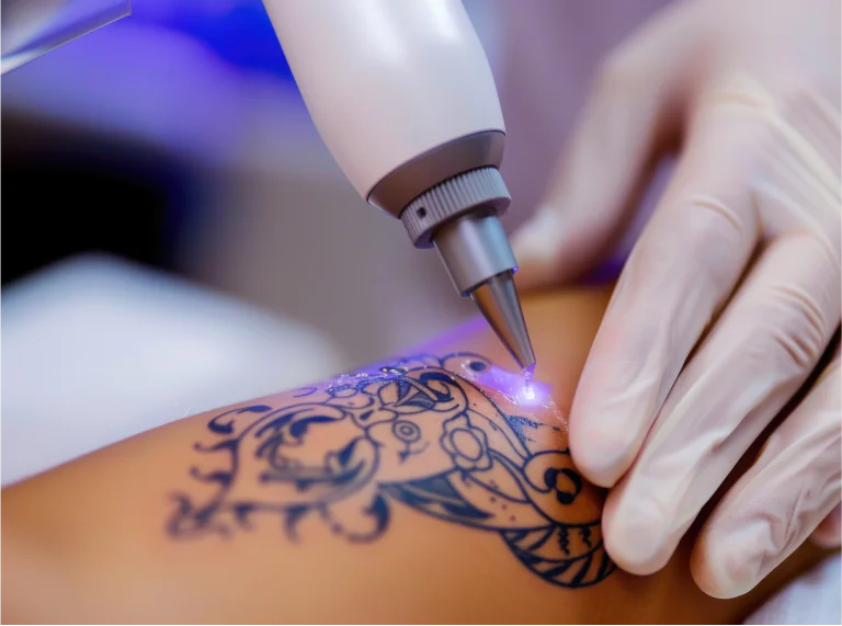 Laser Tattoo Removal in Ambawadi, Ahmedabad