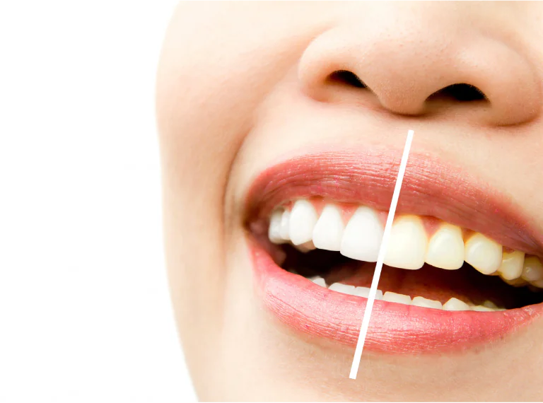 Teeth Whitening Treatment in Ahmedabad