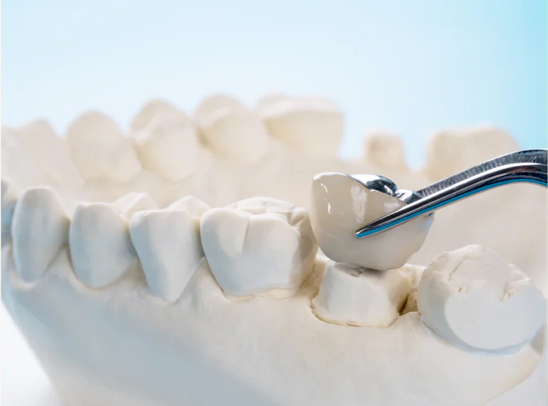Dental Crown Treatment in Ahmedabad