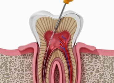 Root Canal Treatment Ahmedabad