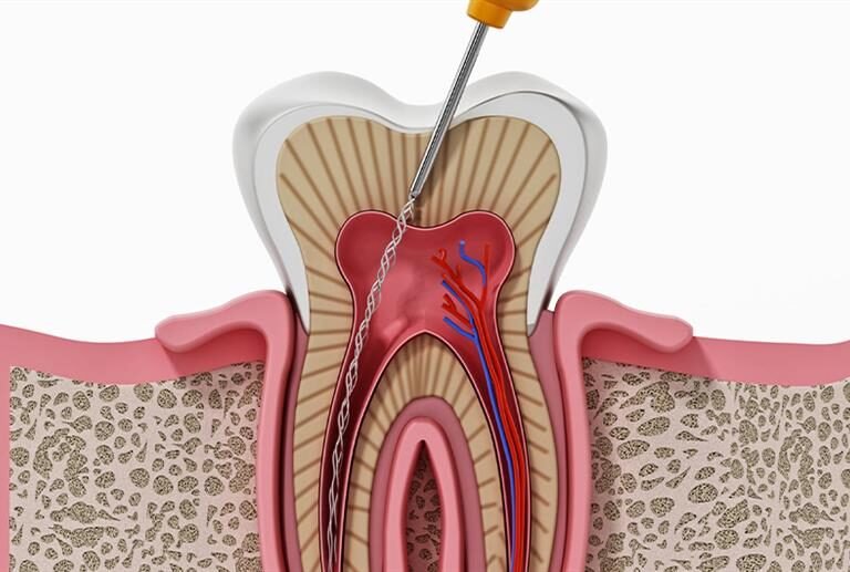 Root Canal Treatment Ahmedabad