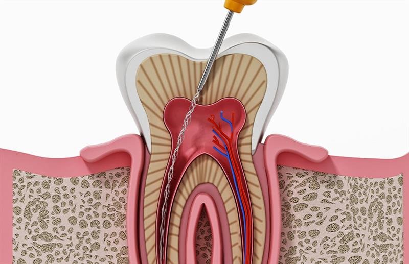 Root Canal Treatment Ahmedabad