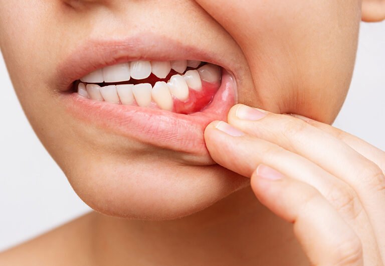 Symptoms of Gum Disease