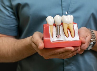 Dental Implants Treatment Ahmedabad