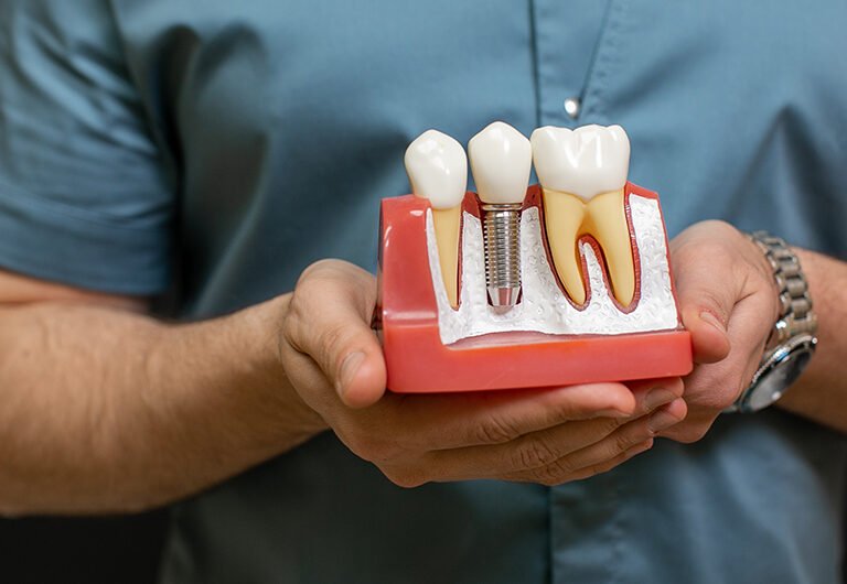Dental Implants Treatment Ahmedabad
