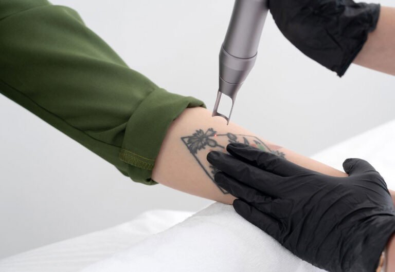 How-to-Remove-a-Tattoo-Permanently-Best-Medical-Methods-That-Actually-Work Permanently Tattoo Remove Treatment in Ahmedabad