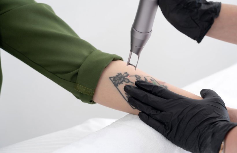 Permanently Tattoo Remove Treatment in Ahmedabad