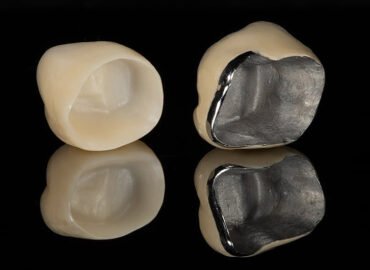 best dental crown in Ahmedabad