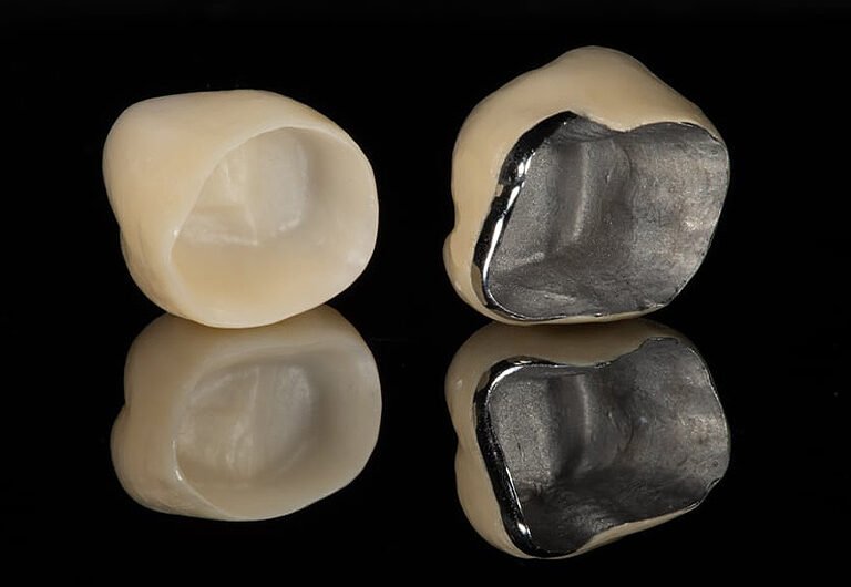 best dental crown in Ahmedabad