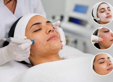 Acne Treatment in Ahmedabad Acne Treatment in Ahmedabad