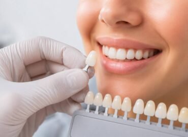 Dental Veneers Cost in Ahmedabad Dental Veneers Cost in Ahmedabad