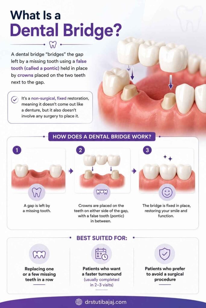 What Is a Dental Bridge