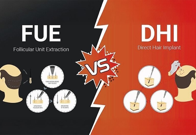 FUE vs DHI Hair Transplant FUE vs DHI Hair Transplant Ahmedabad