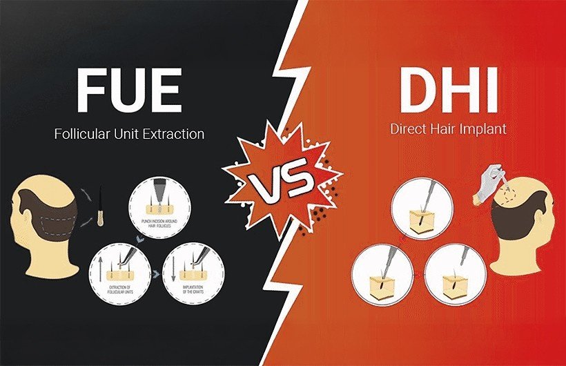 FUE vs DHI Hair Transplant Ahmedabad